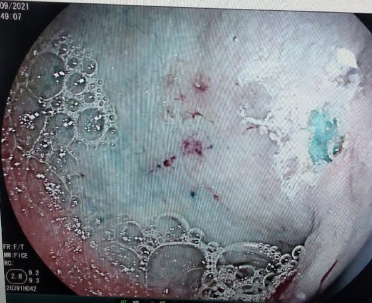 ERCP related endoscopic image