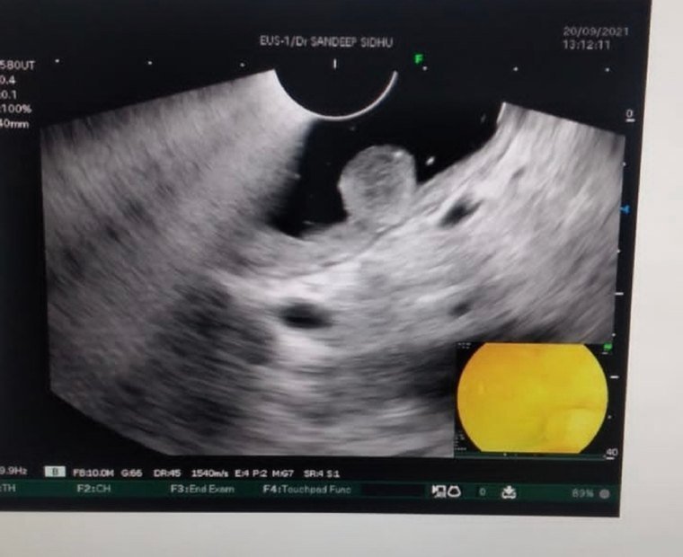 Endoscopic ultrasound visual
