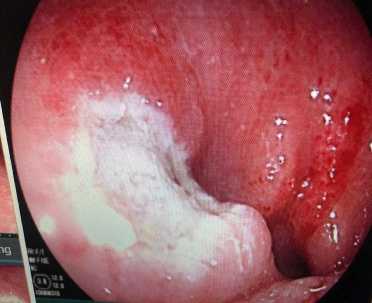 Colonoscopy procedure