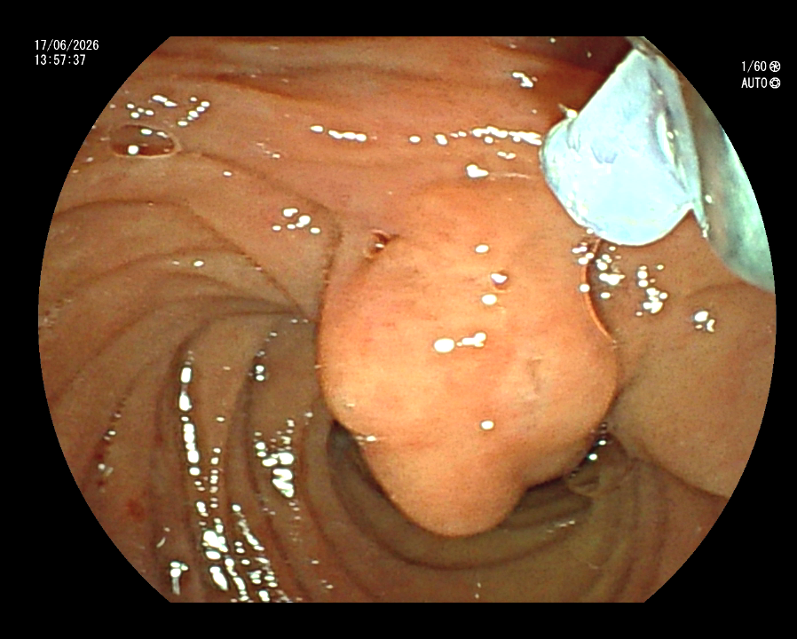 Ampulectomy