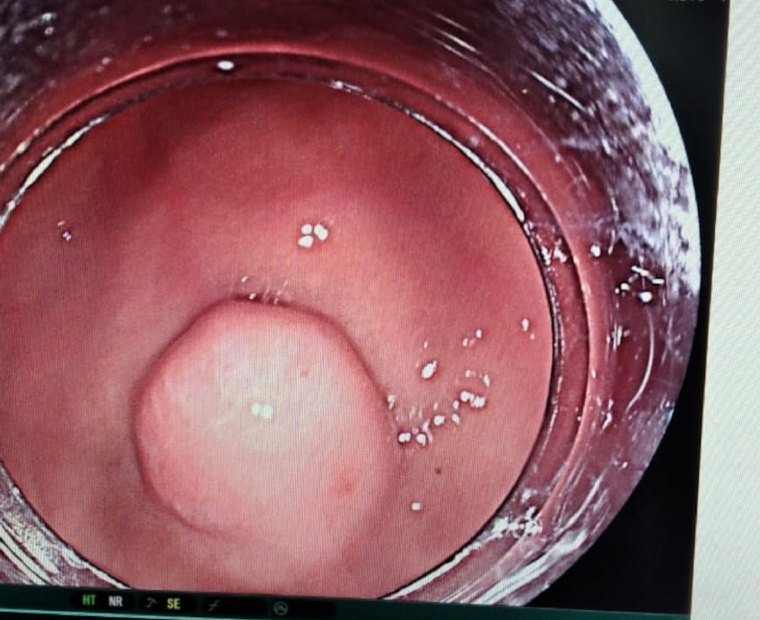 Upper GI Endoscopy