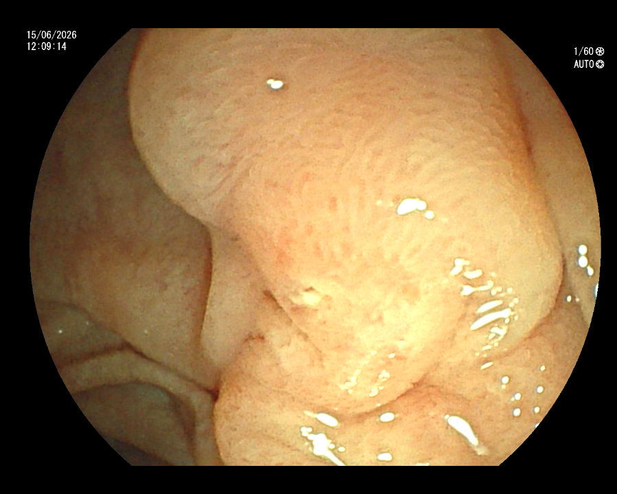 ERCP
