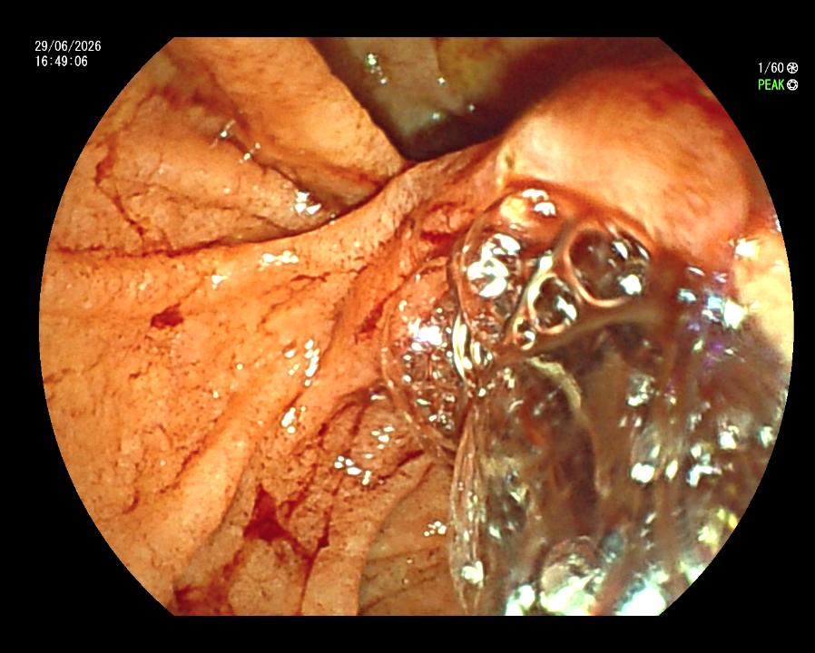 ERCP