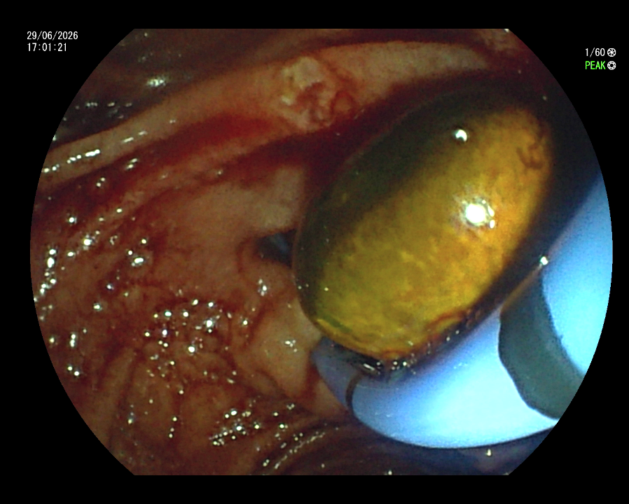 ERCP