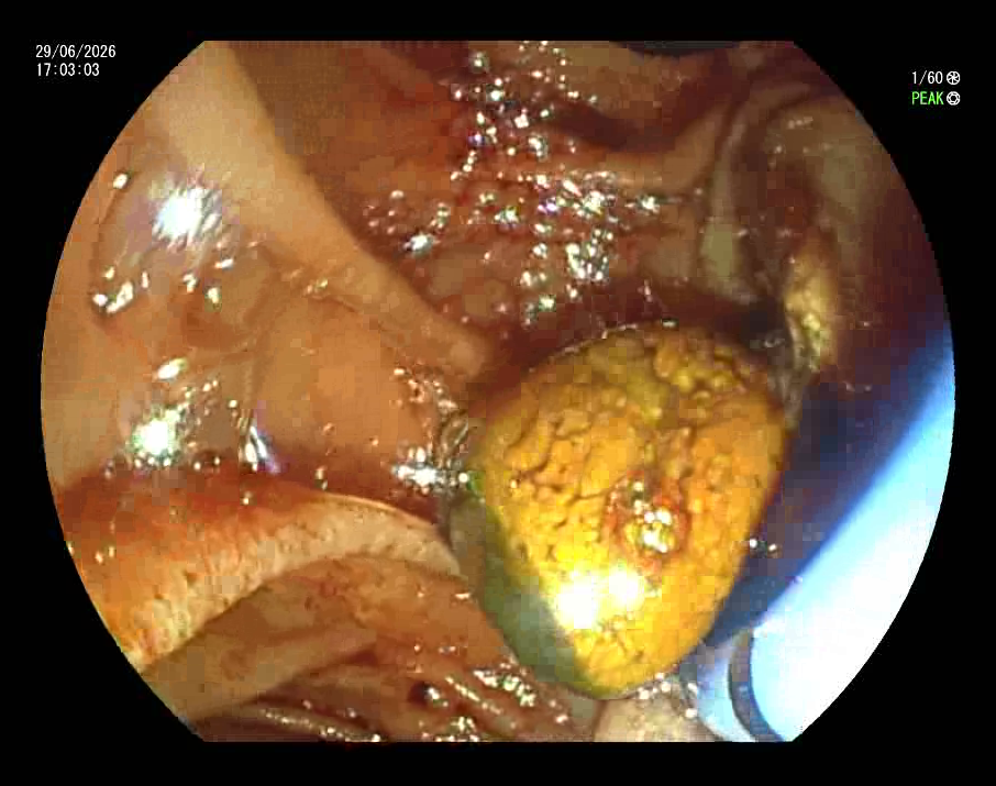 ERCP