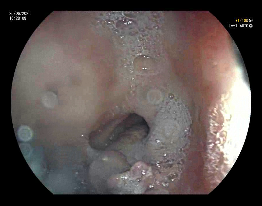 Stricture