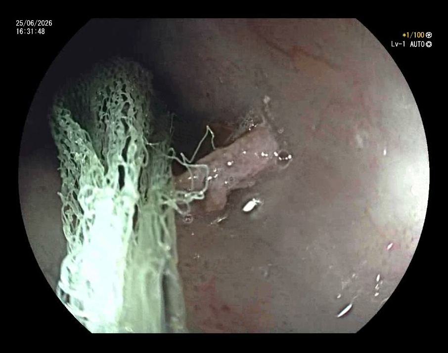 Stricture