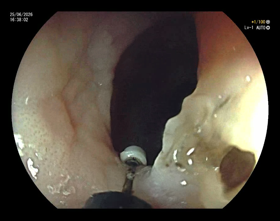 Stricture
